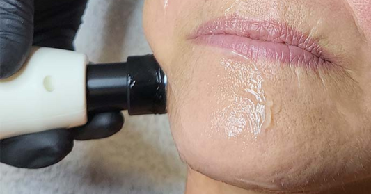 Radiofrequenza, il trattamento anti-age che risveglia la tua bellezza naturale