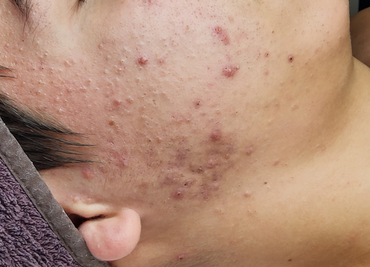 acne adolescenziale
