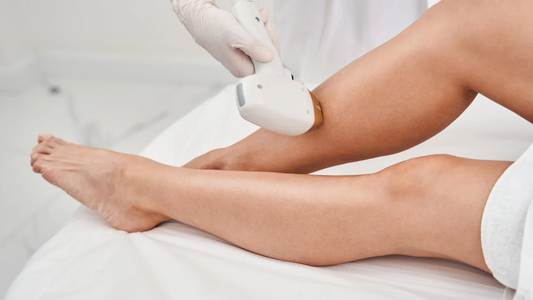 Epilazione laser alle gambe: quante sedute servono e perché la sesta è la più pericolosa