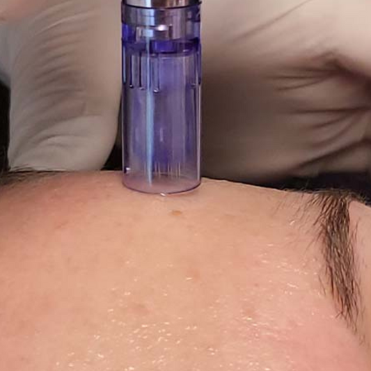Texture della pelle del viso prima di trattamento microneedling personalizzato per cicatrici e rughe