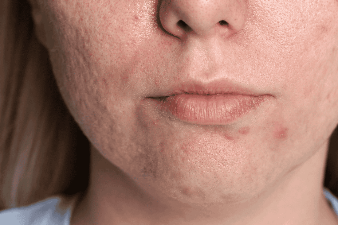 Acne e cicatrici da acne valutate durante una consulenza viso personalizzata