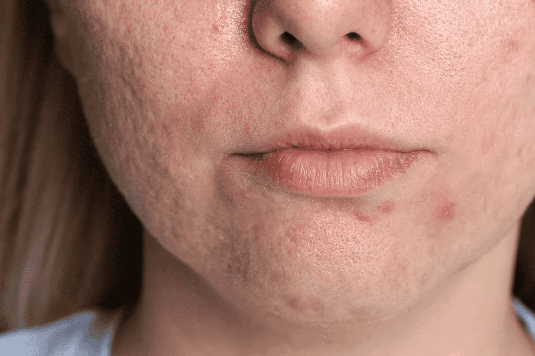Acne e cicatrici da acne valutate durante una consulenza viso personalizzata