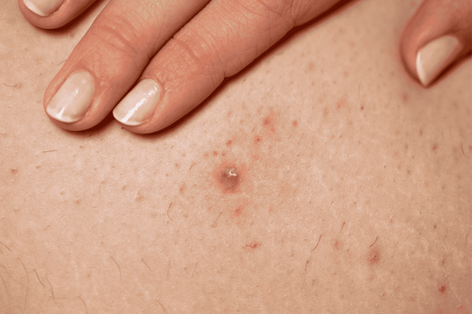 Follicolite cronica dopo ceretta e rasoio: epilazione laser come soluzione preventiva per irritazioni ricorrenti a Padova e Piove