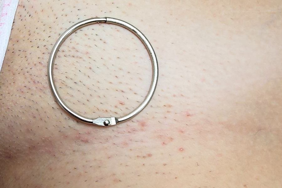 Donna con ovaio policistico che valuta l'epilazione laser: percorso personalizzato per squilibri ormonali e PCOS