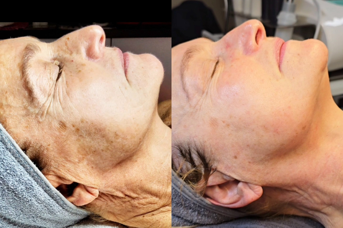 prima e dopo trattamenti estetici viso